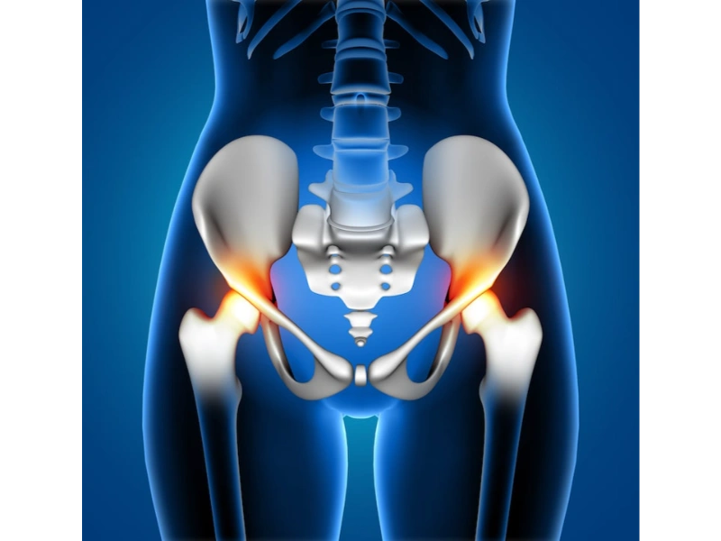 Revision Hip Replacement